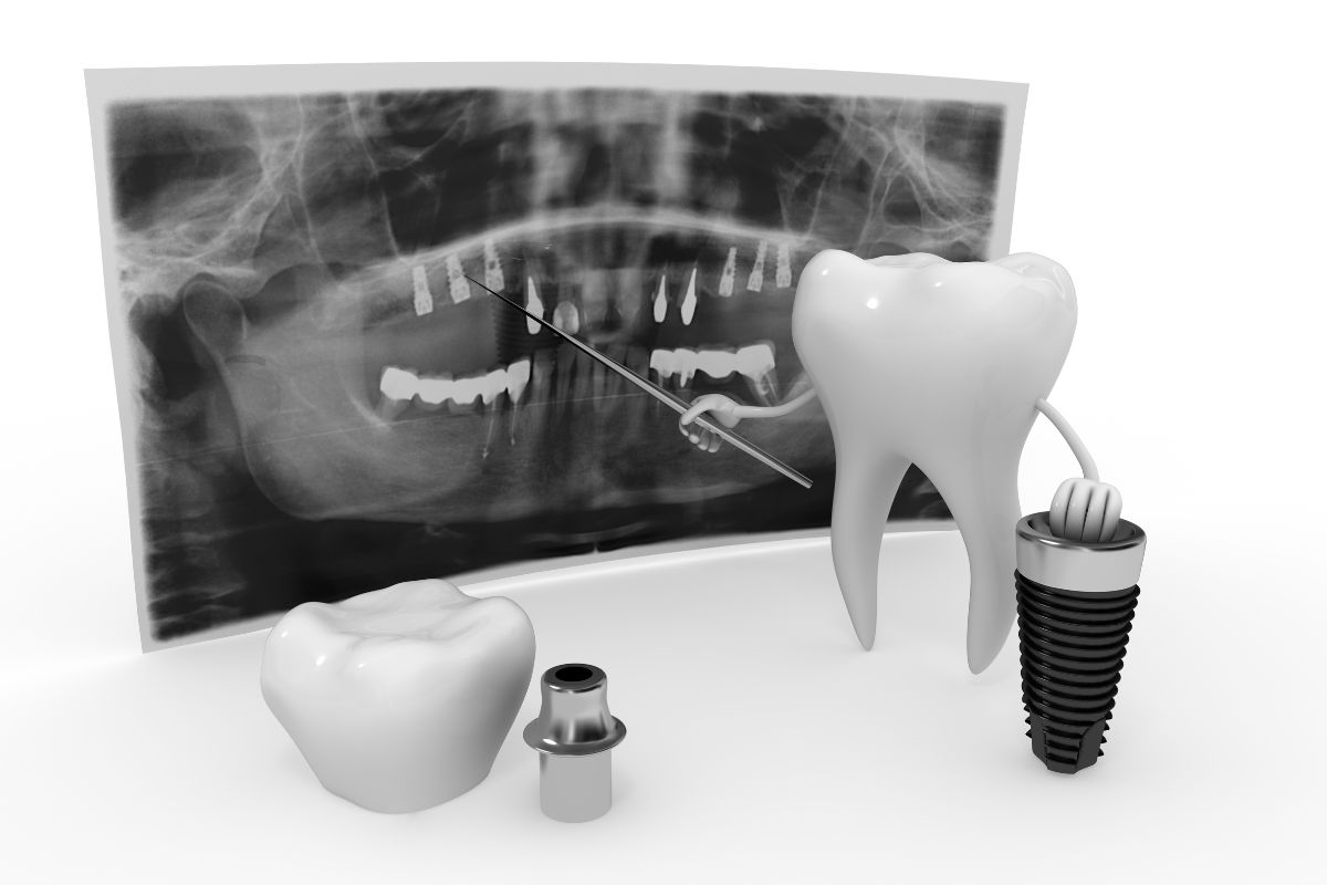 Dental Implants in Fayetteville, NY at CMP Dental Arts