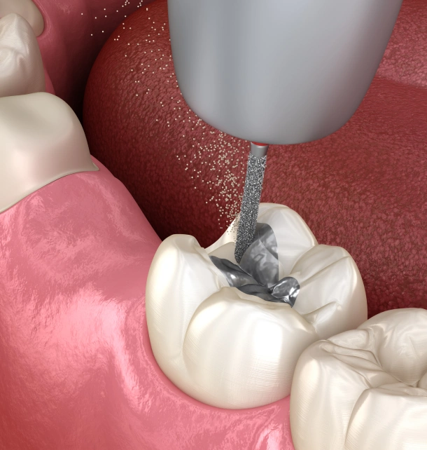 Dental professional using suction tool during tooth extraction procedure in clinical setting.