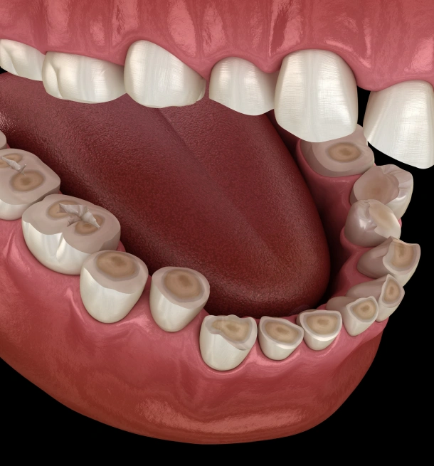Dental model showing upper and lower teeth arrangement for orthodontic or prosthodontic planning.