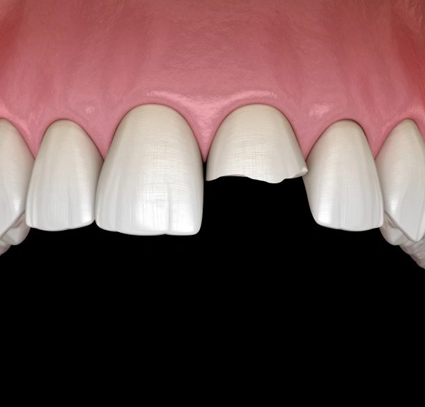 Digital dental model showing six front teeth with one missing tooth gap in center.