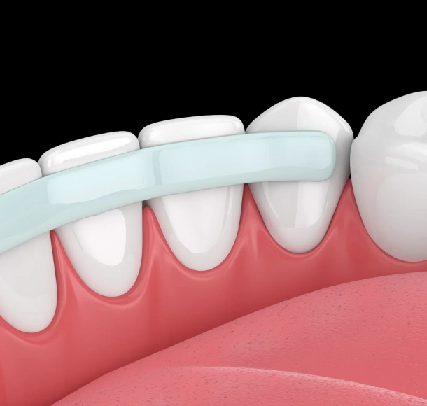 Dental crown placement on teeth showing gum line in dental procedure illustration.