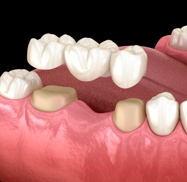 Dental bridge procedure illustration showing tooth replacement between natural teeth on gum model.