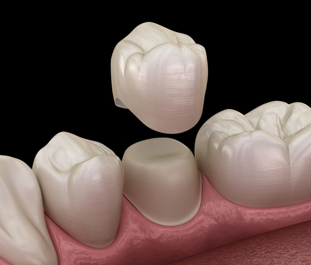Dental crowns and bridges illustration showing tooth restoration on gum model against black background.