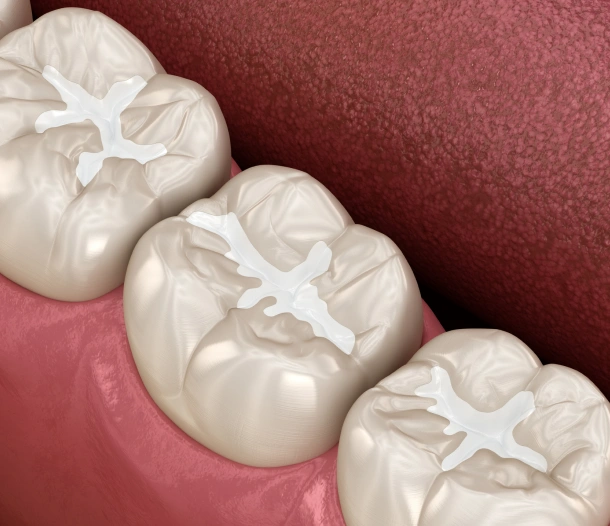 Three white dental crowns displayed on pink dental model showing occlusal surfaces and preparation details.