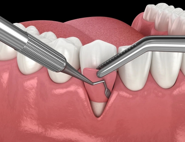 Dental probe examining gum recession between teeth in periodontal examination illustration.