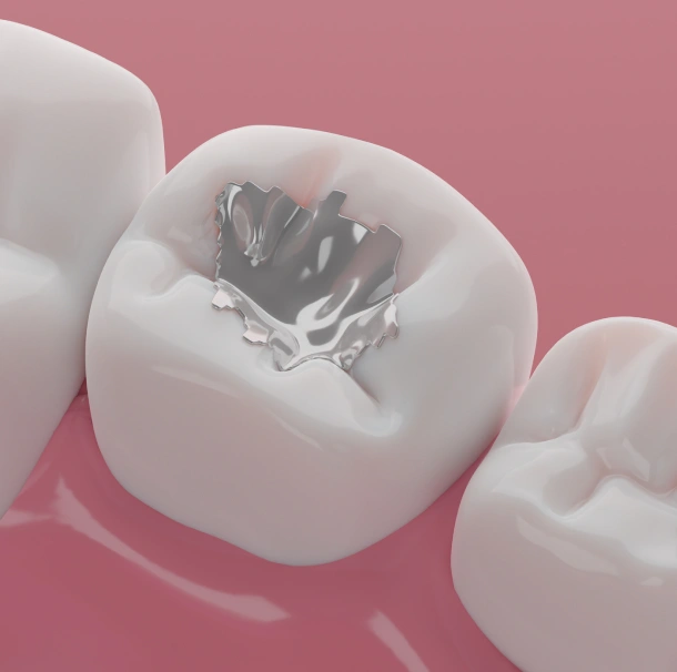 White tooth model showing dental decay or cavity on pink background for dental education.