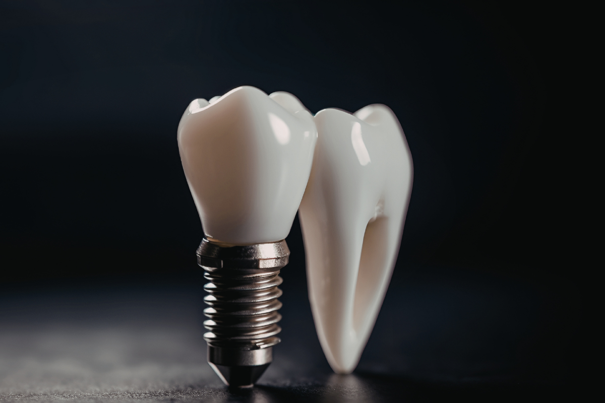 Dental Implants Fayetteville