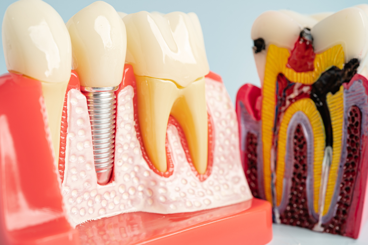 Root Canal Fayetteville