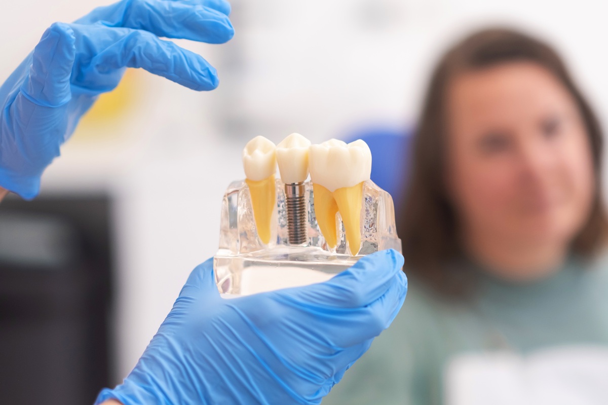 Dental implant model demonstrating the stages of tooth replacement